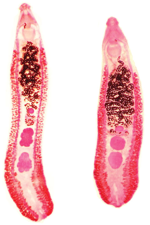 Fascioliasis