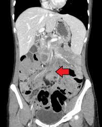 Fibromatosis aggressive