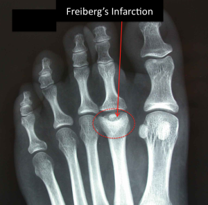 Freiberg disease