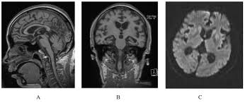 Gerstmann straussler scheinker disease