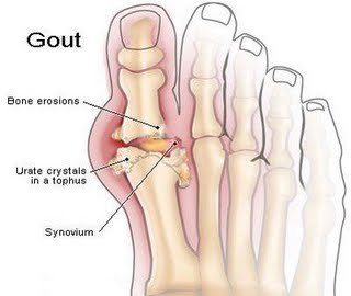 Gout