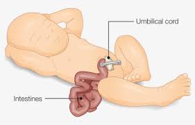 Hernia umbilical