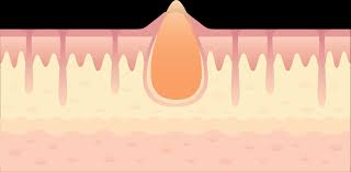Hidradenitis Suppurativa