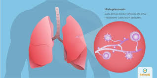 Histoplasmosis