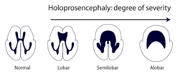 Holoprosencephaly