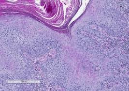 Keratosis actinic