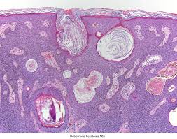 Keratosis seborrheic