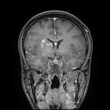 Klipel trenaunay weber syndrome