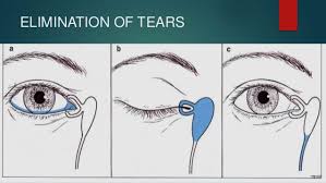 Lacrimal apparatus disease