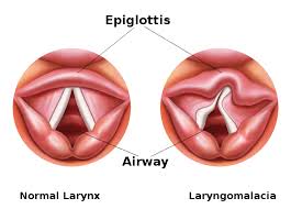 Laryngomalacia