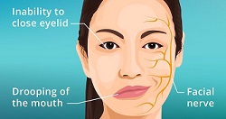 Melkerssom rosenthal syndrome