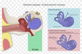 meniere disease