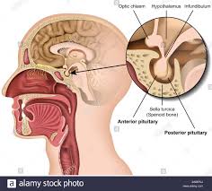 Nelson syndrome