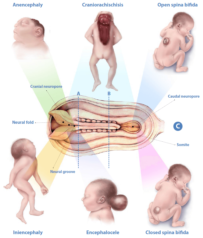 Neural tube defects