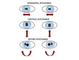 Nystagmus pathologic