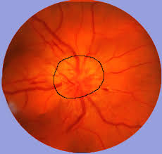 Optic neuritis