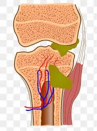 Osteomyelitis