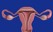 Pelvic inflammatory disease