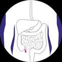 Pseudomyxoma peritonei