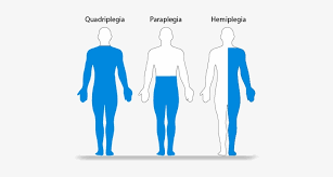 Quadriplegia