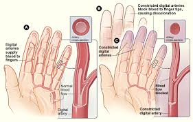 Raynald disease