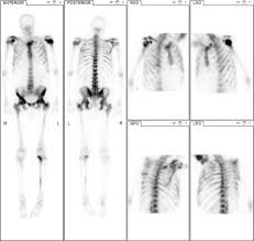 Renal osteodystrophy