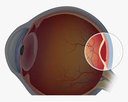 Retinal detachment