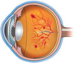 Retinitis pigmentosa