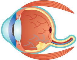 Retinoblastoma