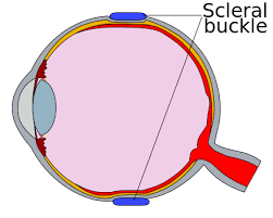 Retinopathy of prematury