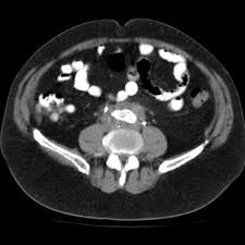 Retroperintoneal fibrosis