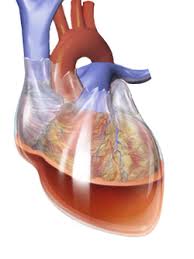 Pericardial effusion