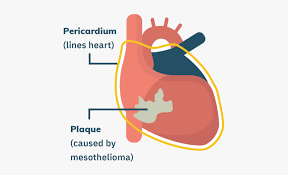 Percarditis