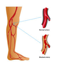 Peripheral vascular disease