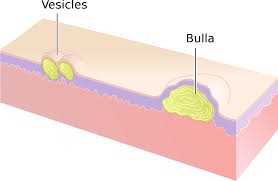 Phemphigoid bullous