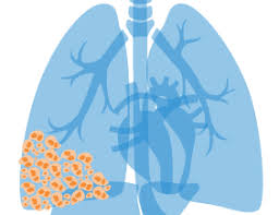 Pulmonary cancer