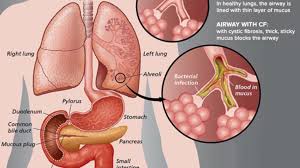 Pulmonary fibrosis