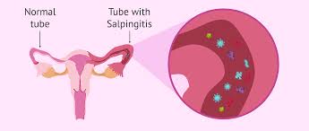 Salpingitis