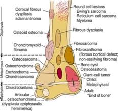 Sarcoma ewings