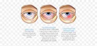 Sceleritis