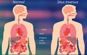 Situs inversus