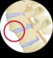 Spondylolithesis