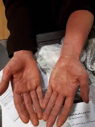 Stevens johnson syndrome