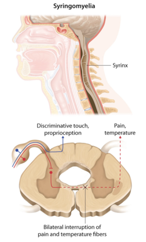 Syringomyelia