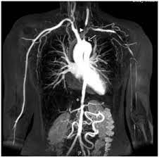 Takayasu arteritis