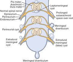 Tarlov cysts