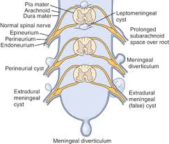 Tarlov cysts