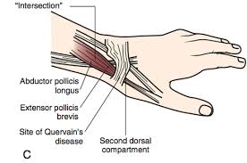 Tenosynovitis/ Finger Trigger