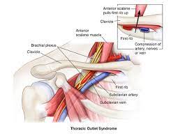 Thoracic outlet syndrome