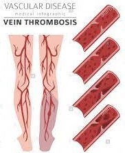 Thrombophlebitis